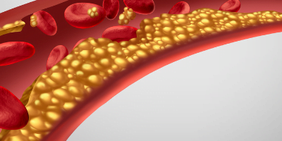 Dr. Rollins Articles 1 The Lipid Highway