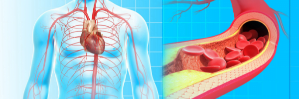 Advanced Testing to Prevent and Reverse Artery Plaque