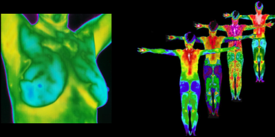 Breast Thermography